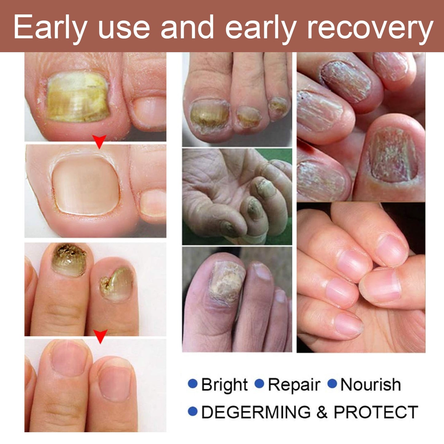 Herbal Antibacterial Nail Treatments Essential Oil, Grey Nail Care Essential Oil Brightening Nail Polish Clean Manicure Foot Care Solution